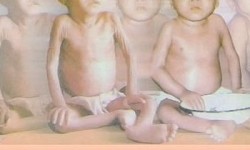 Remaja Penderita Gizi Buruk di Sukabumi Meninggal